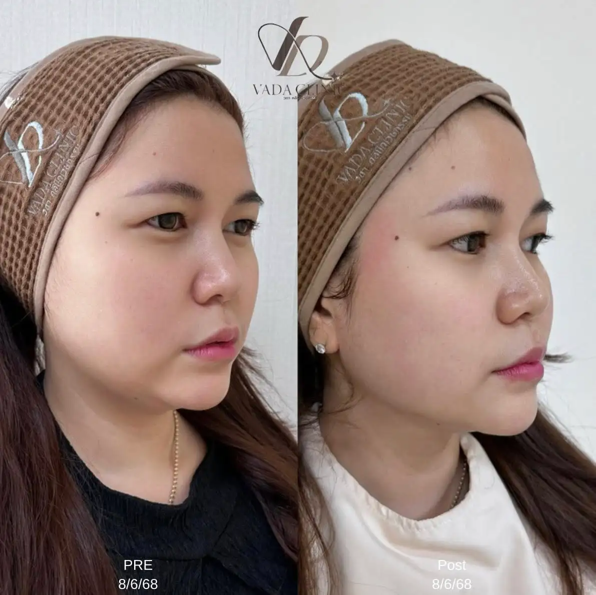 ผลงาน Botox Filler Before After ปรับรูปหน้า สวยธรรมชาติ Vada Clinic บ้านฉาง ระยอง