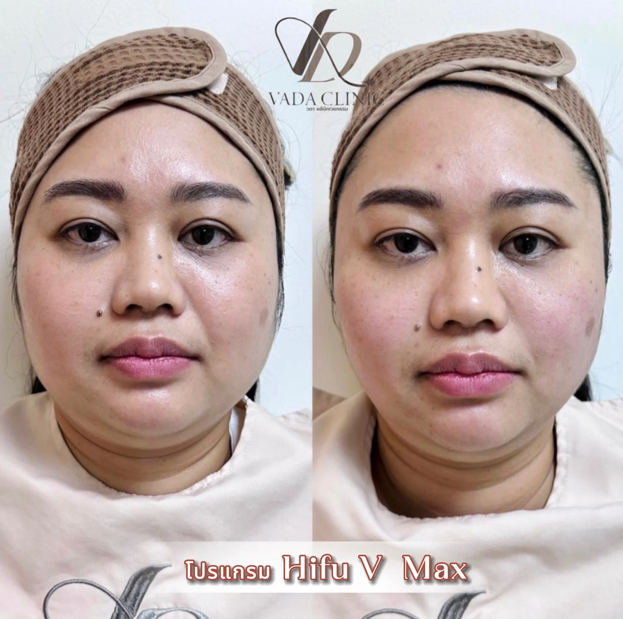 ผลลัพธ์ HIFU RF Before After ยกกระชับหน้า ลดริ้วรอย Vada Clinic บ้านฉาง ระยอง