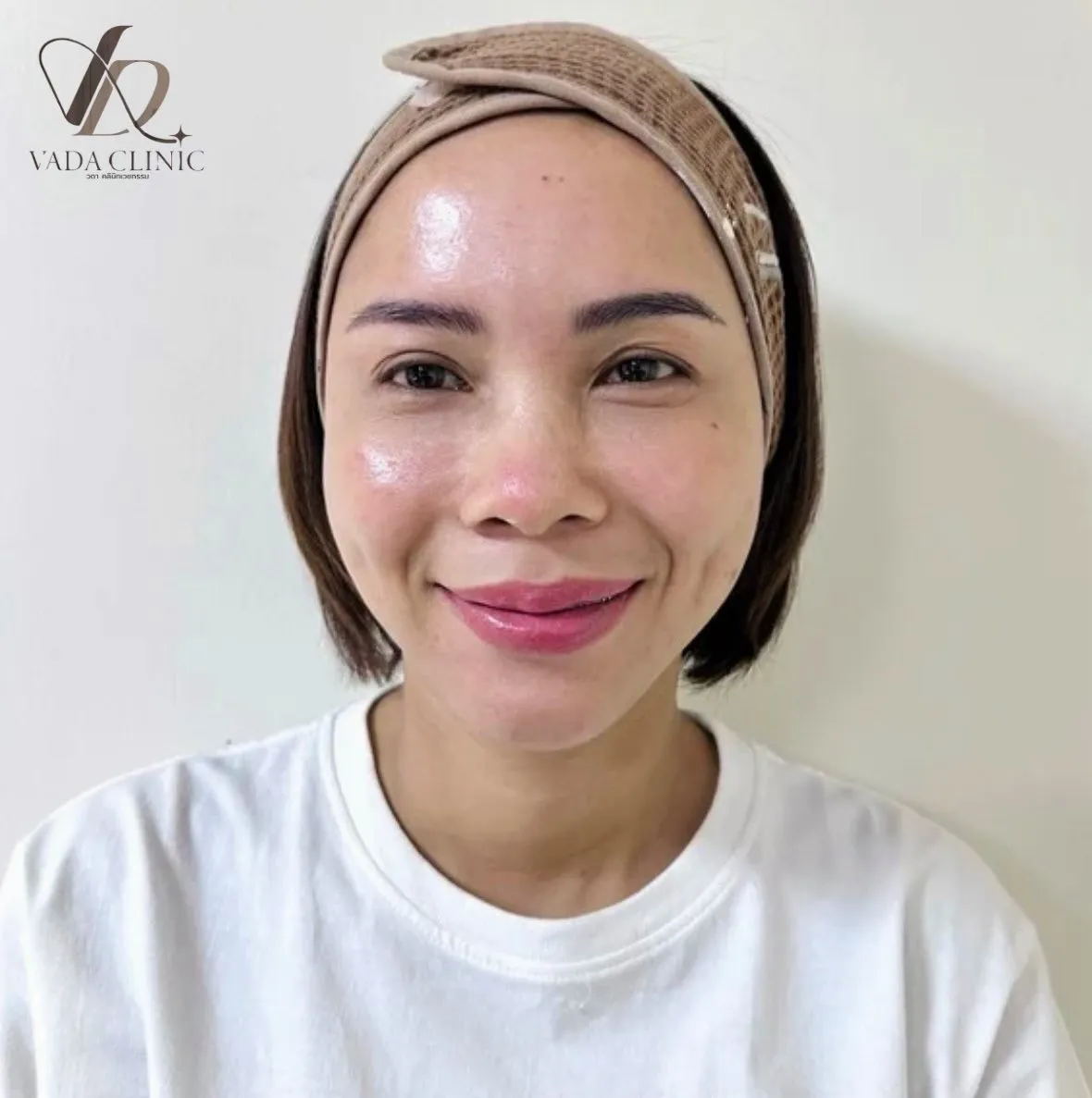 HIFU RF ยกกระชับหน้า ลดริ้วรอย กระชับผิว ไม่ต้องผ่าตัด Vada Clinic บ้านฉาง ระยอง