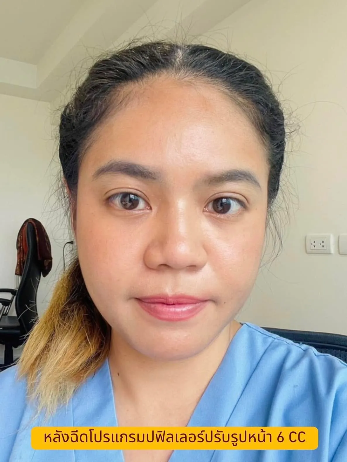 คุณพิมพ์ชนก ลูกค้าโบท็อกซ์และฟิลเลอร์ Vada Clinic